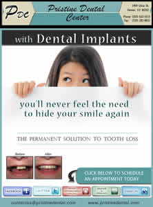 Dental Implants